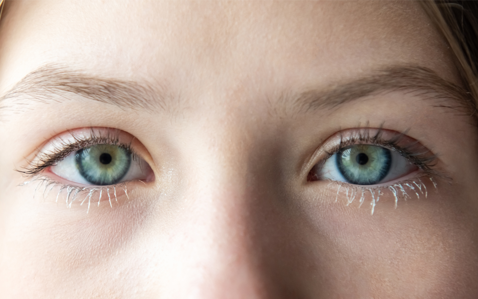 The same eye six weeks after blepharoplasty