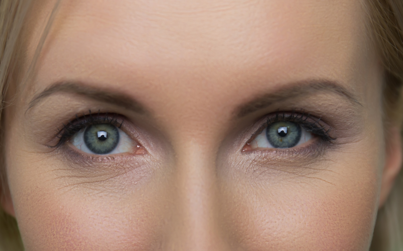 The same eye six weeks after eye bag correction