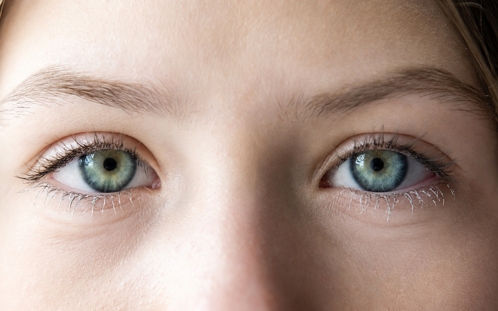 Upper eyelid before blepharoplasty