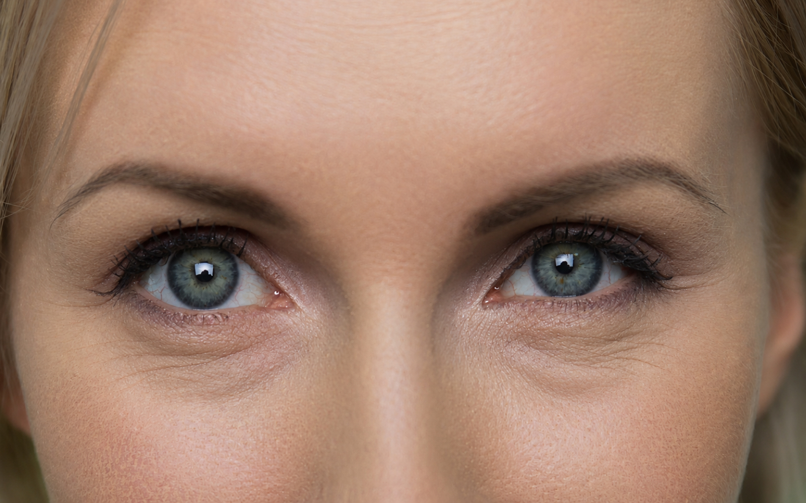 Lower eyelid before eye bag correction